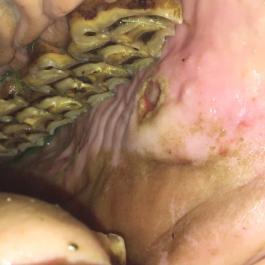 Schleimhautverletzung